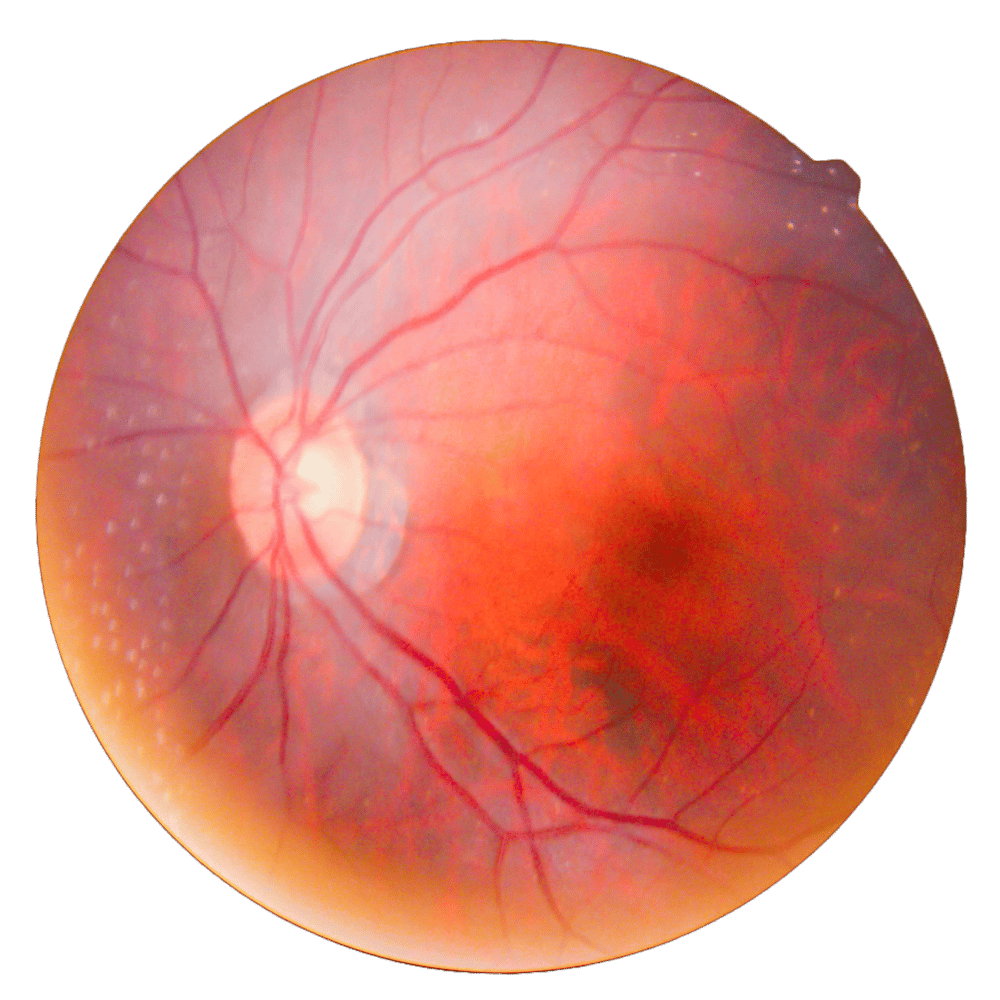 Vitreoretinal l Retina Specialists of Indiana