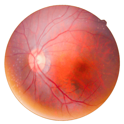 Retina